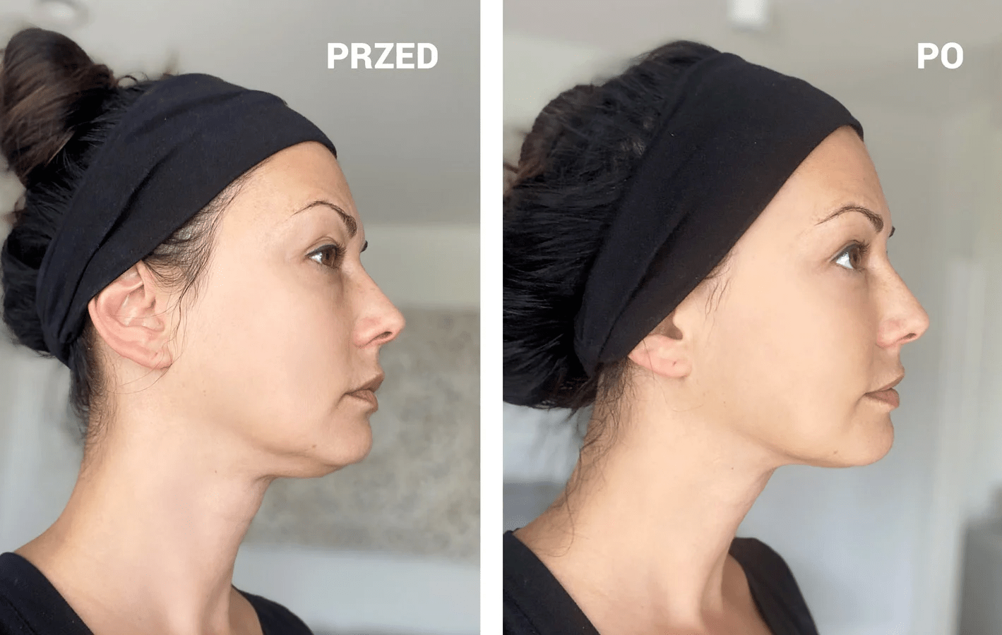 Kinesiotaping estetyczny – efekty przed i po 